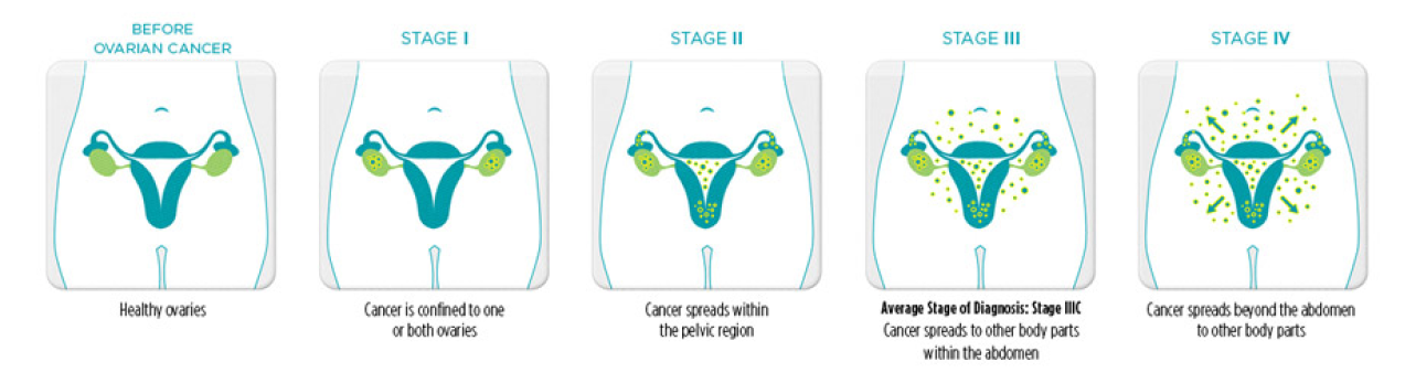 Types And Stages Ovarian Org