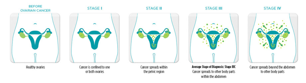 types-and-stages-ovarian