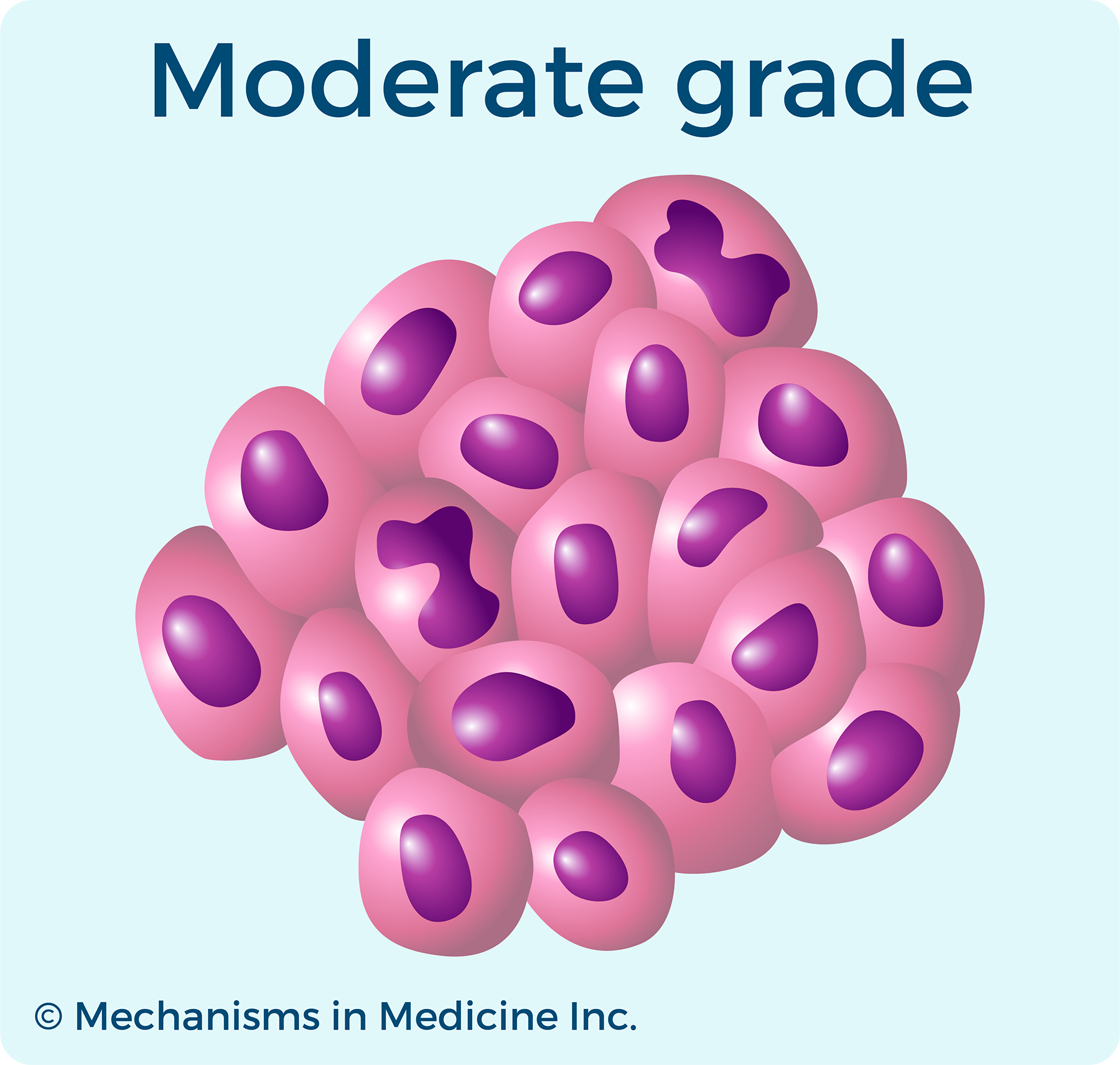 Moderate Grade Ovarian Cancer